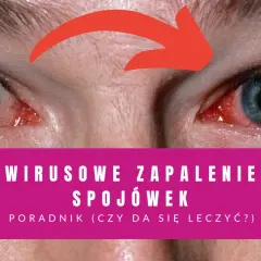Zbliżenie na zaczerwienione oczy z czerwoną strzałką wskazującą na zapalenie spojówek.