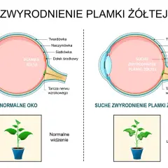 Porównanie budowy oka normalnego i z suchym zwyrodnieniem plamki żółtej. Powikłania tej choroby prowadzą do centralnej utraty wzroku, jak na obrazku rośliny.
