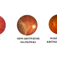Trzy obrazy dna oka: jaskra, odwarstwienie siatkówki i makulopatia krótkowzroczna, pokazujące różne problemy wpływające na ostrość wzroku.
