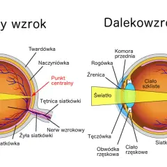 Schemat oka z normalnym wzrokiem i dalekowzrocznością, pokazujący skupienie światła.