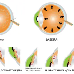 Od czego jest jaskra? Poznaj przyczyny i ryzyko tej choroby oczu