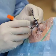 Chirurg wykonuje zastrzyk w oko pacjenta, używając precyzyjnych narzędzi i strzykawki.