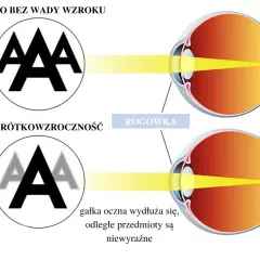 Czy wada wzroku może się zmniejszyć? Odkryj prawdę o poprawie widzenia