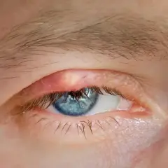 Żółta kępka na czerwonej powiece oka z niebieską tęczówką.