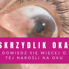 Zbliżenie na oko z widocznym skrzydlikiem.