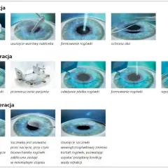 Ilustracje przedstawiające etapy zabiegów laserowej korekcji wzroku: PRK, LASIK i SMILE.