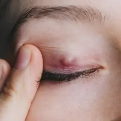 Zaczerwienione, opuchnięte oko z widocznym guzem na powiece, dotykane palcem.