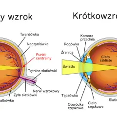 Schemat oka z normalnym wzrokiem i krótkowzrocznością. Czy wada wzroku minus może się cofnąć? Ilustracja pokazuje różnice w ogniskowaniu światła.