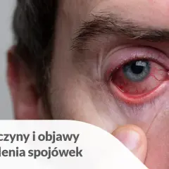 Silnie zaczerwienione oko z widocznymi naczynkami. To objaw zapalenia spojówek, które może być spowodowane różnymi czynnikami, w tym infekcjami lub alergią.