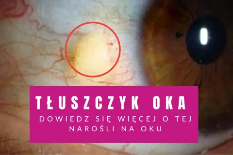 Zbliżenie na oko z żółtawym tłuszczykiem otoczonym czerwonym okręgiem.