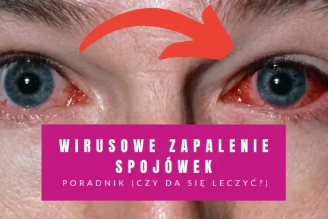 Zbliżenie na zaczerwienione oczy z czerwoną strzałką wskazującą na zapalenie spojówek.