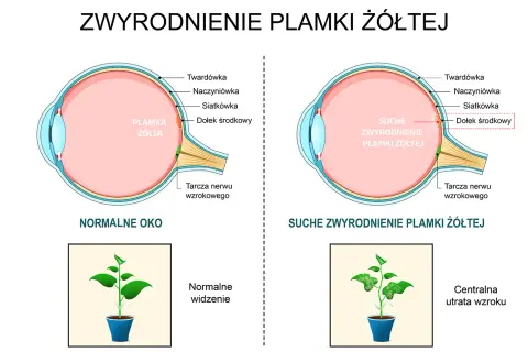 Porównanie budowy oka z plamką żółtą w stanie normalnym i z suchym zwyrodnieniem. Obrazek pokazuje, jak plamka żółta wpływa na widzenie.