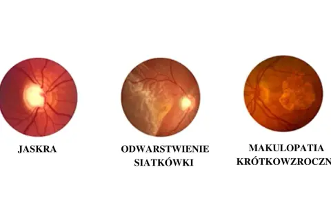 Trzy obrazy dna oka: jaskra, odwarstwienie siatkówki i makulopatia krótkowzroczna, pokazujące różne problemy wpływające na ostrość wzroku.