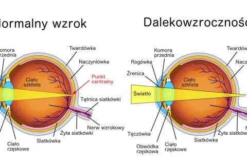 Schemat oka z normalnym wzrokiem i dalekowzrocznością, pokazujący skupienie światła.