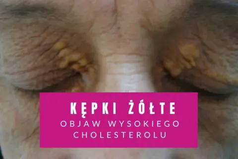 Żółte kępki na powiekach, widoczne na zbliżeniu.
