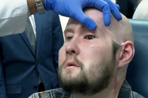 Lekarz w niebieskiej rękawiczce bada oko pacjenta po przeszczepie.