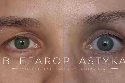Przed i po zabiegu blefaroplastyki powiek. Zobacz, jak odmłodzić spojrzenie i dowiedz się, jaka jest blefaroplastyka powiek cena.