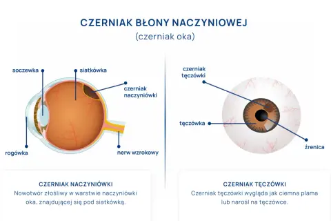 Ilustracja przekroju oka z zaznaczonym czerniakiem naczyniówki oraz widok oka z czerniakiem tęczówki.