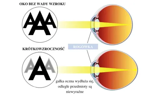 Czy wada wzroku może się zmniejszyć? Odkryj prawdę o poprawie widzenia