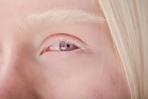 Zbliżenie oka osoby z albinizmem, z widoczną jasną skórą, blond brwiami i rzęsami oraz fioletową tęczówką.