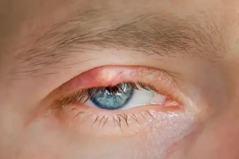 Żółta kępka na czerwonej powiece oka z niebieską tęczówką.