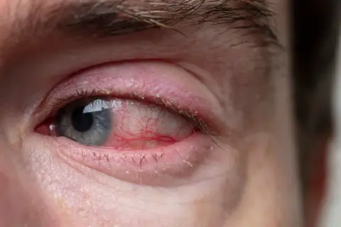 Silne zaczerwienienie oka i powieki, objawy atopowego zapalenia spojówek. Widać drobne łuski na rzęsach.