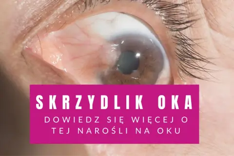 Zbliżenie na oko z widocznym skrzydlikiem.