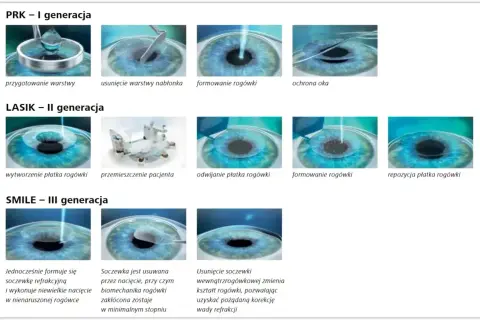 Ilustracje przedstawiające etapy zabiegów laserowej korekcji wzroku: PRK, LASIK i SMILE.