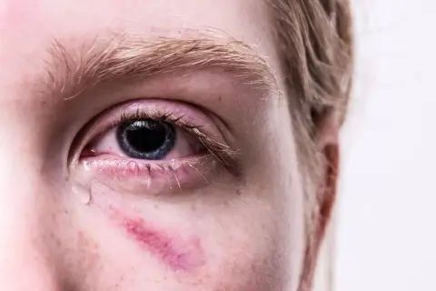 Zbliżenie oka z zaczerwienieniem i siniakiem pod nim, łza spływająca po policzku.