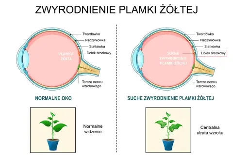 Porównanie budowy oka z metamorfopsjami. Po lewej zdrowe oko i normalne widzenie rośliny. Po prawej suche zwyrodnienie plamki żółtej i widzenie z centralną utratą wzroku.