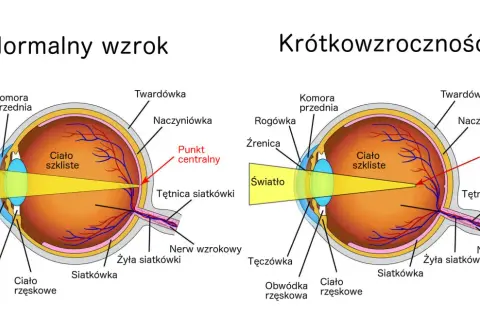 Schemat oka z normalnym wzrokiem i krótkowzrocznością. Czy wada wzroku minus może się cofnąć? Ilustracja pokazuje różnice w ogniskowaniu światła.