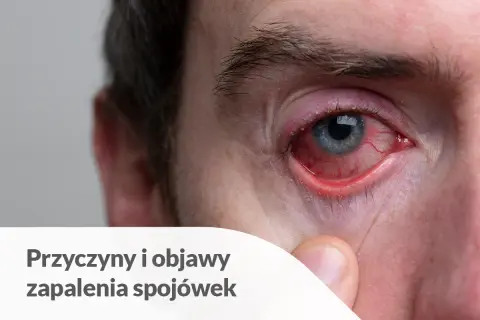 Silnie zaczerwienione oko z widocznymi naczynkami. To objaw zapalenia spojówek, które może być spowodowane różnymi czynnikami, w tym infekcjami lub alergią.