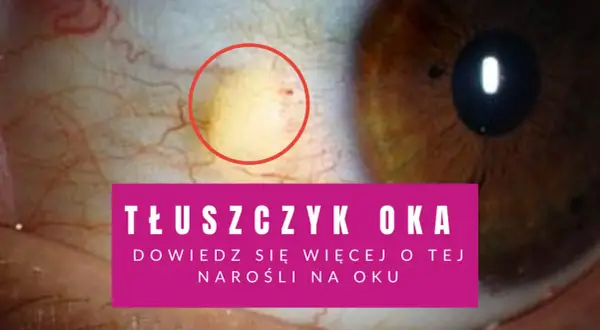 Zbliżenie na oko z żółtawym tłuszczykiem otoczonym czerwonym okręgiem.