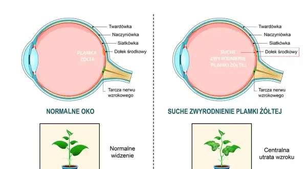 Porównanie budowy oka normalnego i z suchym zwyrodnieniem plamki żółtej. Powikłania tej choroby prowadzą do centralnej utraty wzroku, jak na obrazku rośliny.