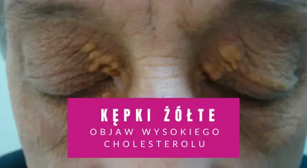 Żółte kępki na powiekach, widoczne na zbliżeniu.