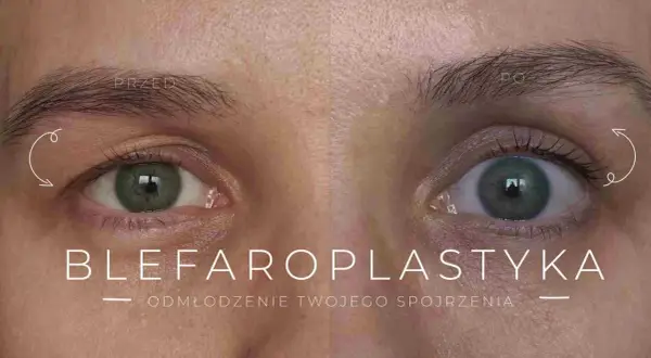 Przed i po zabiegu blefaroplastyki powiek. Zobacz, jak odmłodzić spojrzenie i dowiedz się, jaka jest blefaroplastyka powiek cena.