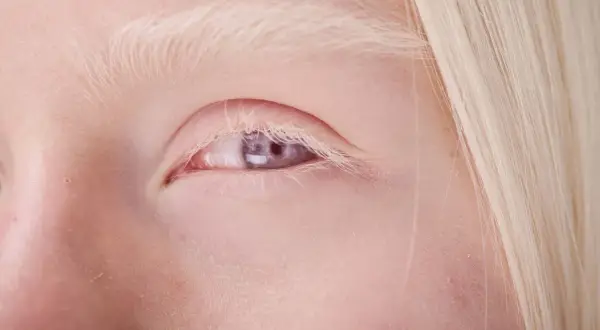 Zbliżenie oka osoby z albinizmem, z widoczną jasną skórą, blond brwiami i rzęsami oraz fioletową tęczówką.