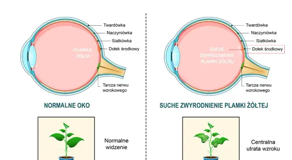 Porównanie zdrowego oka z suchym zwyrodnieniem plamki żółtej. Objawy: normalne widzenie vs. centralna utrata wzroku.