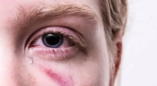 Zbliżenie oka z zaczerwienieniem i siniakiem pod nim, łza spływająca po policzku.