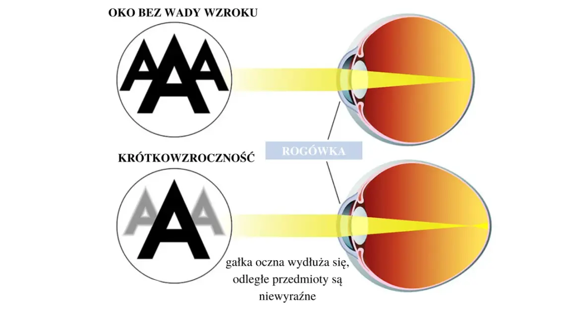 Czy wada wzroku może się zmniejszyć? Odkryj prawdę o poprawie widzenia