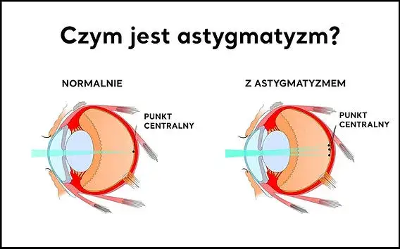 Zdjęcie Czy astygmatyzm to zez? Poznaj różnice i wpływ na widzenie