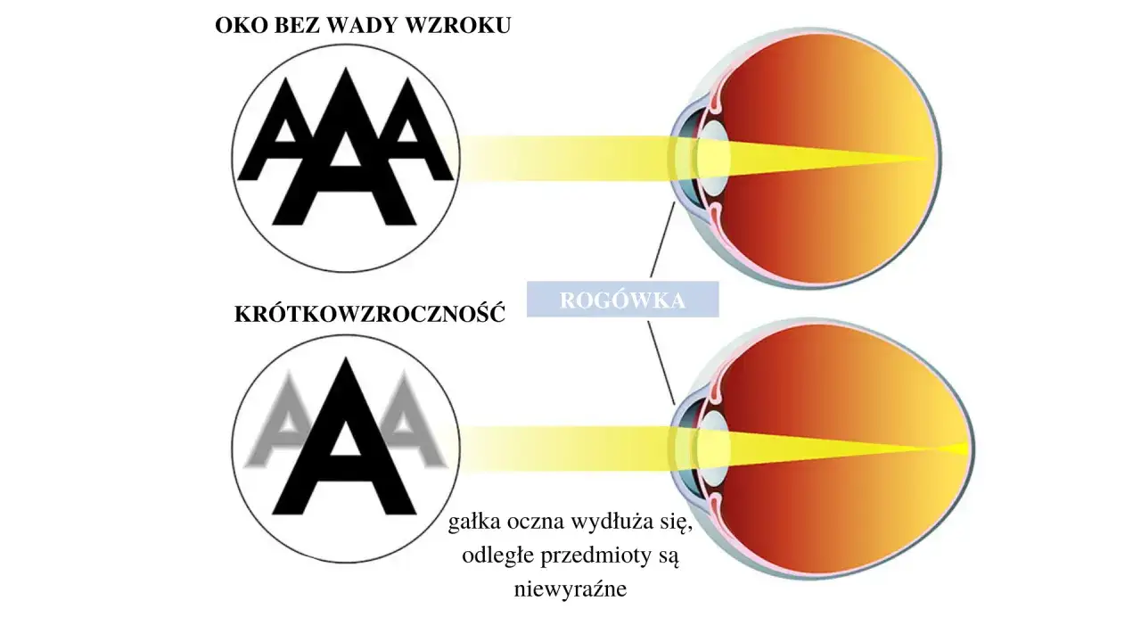Zdjęcie Jakie wady wzroku kwalifikują do renty? Sprawdź kryteria i warunki