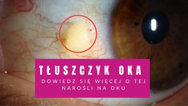 Zbliżenie na oko z żółtawym tłuszczykiem otoczonym czerwonym okręgiem.