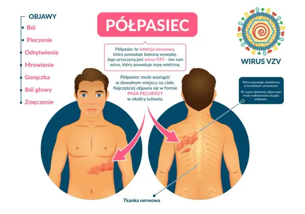 Ilustracja przedstawia objawy półpaśca: wysypkę na tułowiu i plecach, wirusa VZV oraz listę objawów.