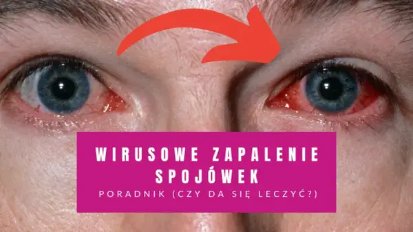 Zbliżenie na zaczerwienione oczy z czerwoną strzałką wskazującą na zapalenie spojówek.
