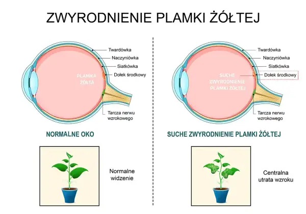 Porównanie budowy oka normalnego i z suchym zwyrodnieniem plamki żółtej. Powikłania tej choroby prowadzą do centralnej utraty wzroku, jak na obrazku rośliny.