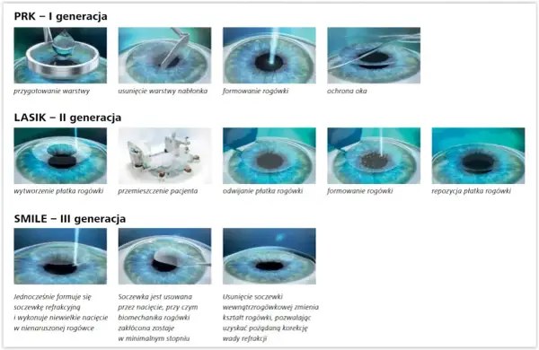 Ilustracje przedstawiające etapy zabiegów laserowej korekcji wzroku: PRK, LASIK i SMILE.
