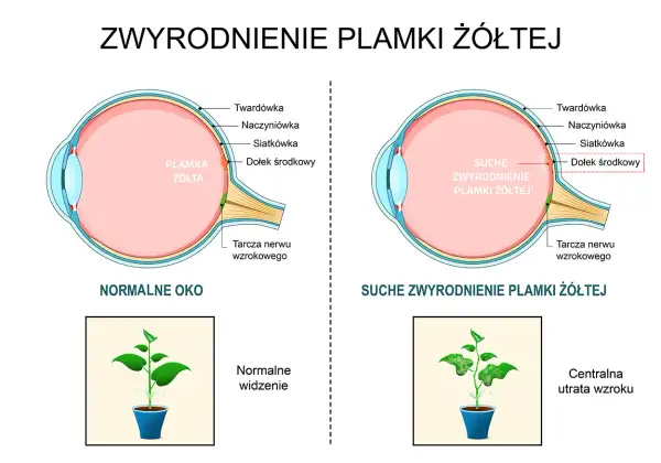 Porównanie budowy oka z plamką żółtą w stanie normalnym i z suchym zwyrodnieniem. Obrazek pokazuje, jak plamka żółta wpływa na widzenie.