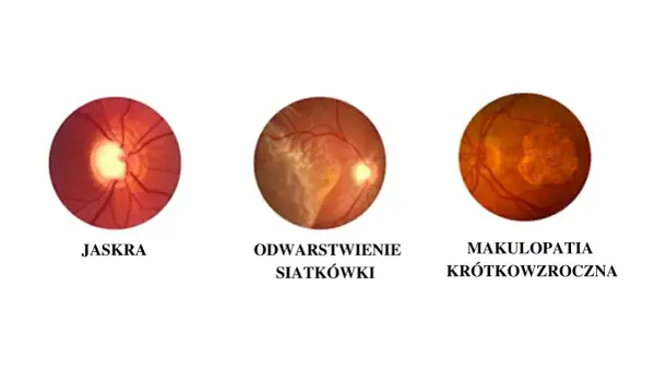 Trzy obrazy dna oka: jaskra, odwarstwienie siatkówki i makulopatia krótkowzroczna, pokazujące różne problemy wpływające na ostrość wzroku.