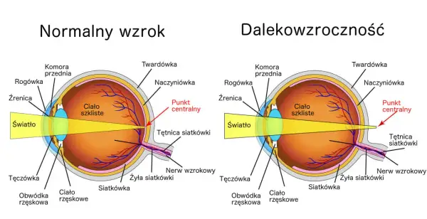 Schemat oka z normalnym wzrokiem i dalekowzrocznością, pokazujący skupienie światła.